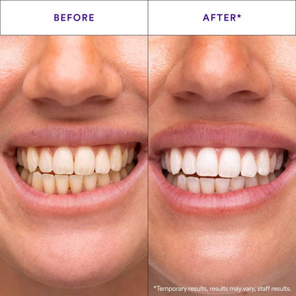 HiSmile | Whitening Strips